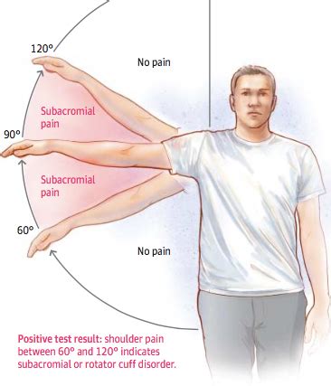 special tests for subacromial impingement